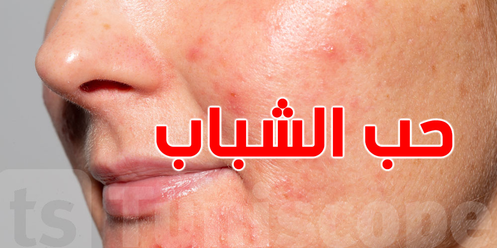 حب الشباب: مش كان الدهون… أطعمة يومية تنجم تكون السبب!