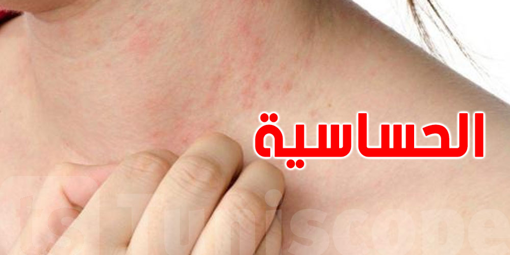 عاجل: ابتكار لقاح جديد لعلاج الحساسية الشديدة قد يغيّر حياة الملايين