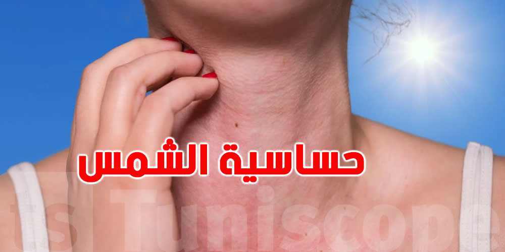 الشمس تنجم تضرّك؟ احذر من حساسية الشمس