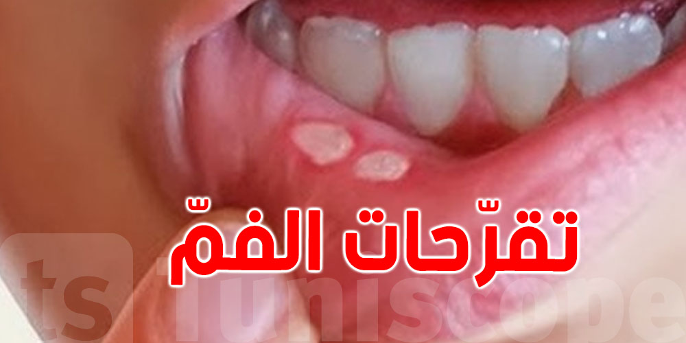 تعاني من تقرّحات في الفمّ؟: دكتورة مختصّة تفسّرلك وتنصحك
