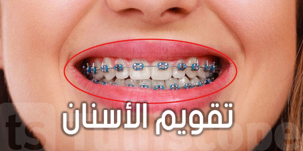 هذه مدة ارتداء ''تقويم الأسنان'' اللي يلزمك تعرفها