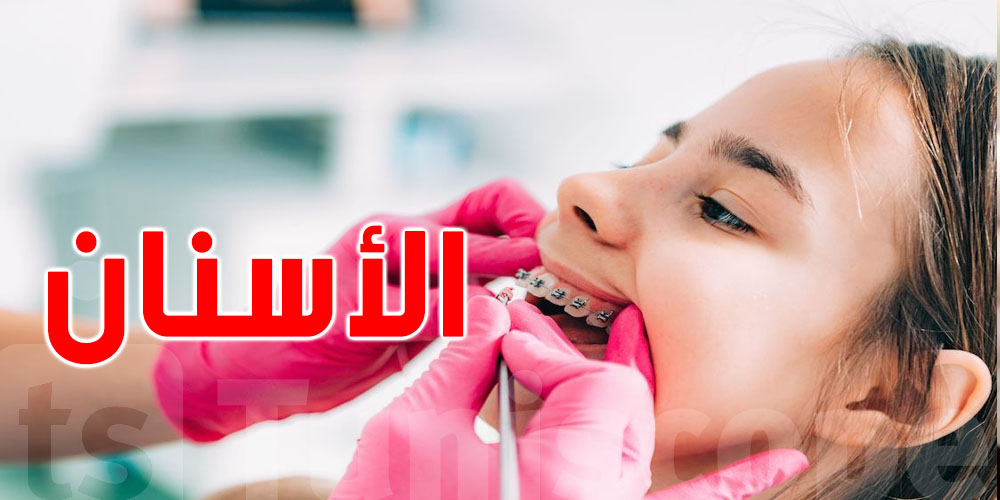 تونس : أنواع و أسعار تقويم الأسنان 