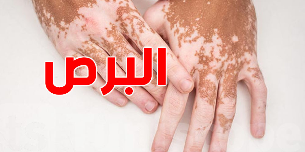 منين يجي مرض البُهاق ''البرص''؟..وهل هو مرض معدي؟