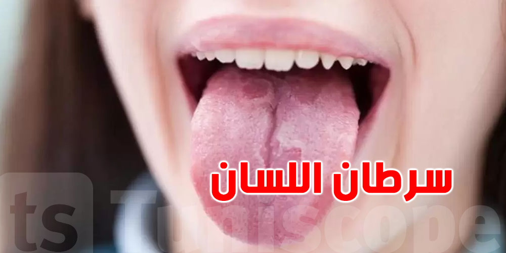 ما تستهينش بيها.. علامة في لسانك تنجم تكون إنذار لمرض خطير