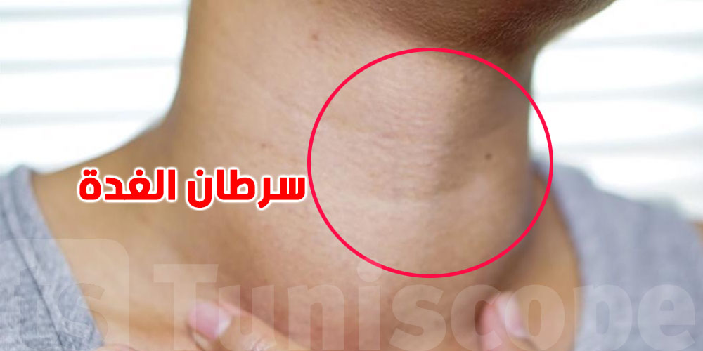 سرطان الغدة الدرقية.. 6 علامات ما تتجاهلهاش