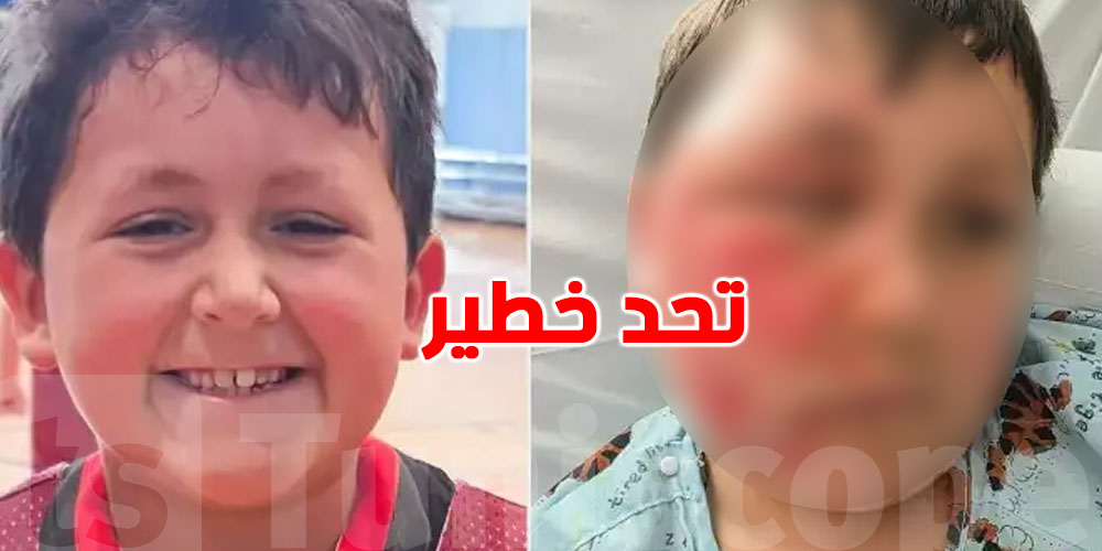 صادم: إصابة طفل بحروق خطيرة بعد تقليد تحد خطير على ''تيك توك''