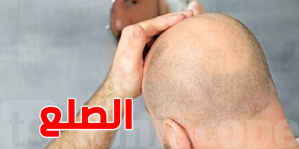 بشرى سارة لمرضى الصلع: نموّ الشعر من جديد خلال 20 يوماً فقط