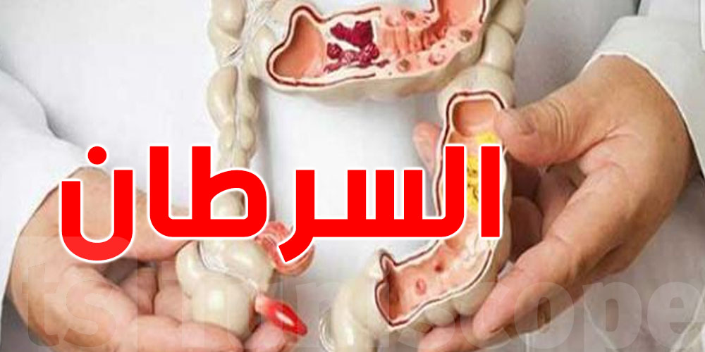 حذاري! هاذم أهم العوامل اللي ترفع خطر سرطان المعدة