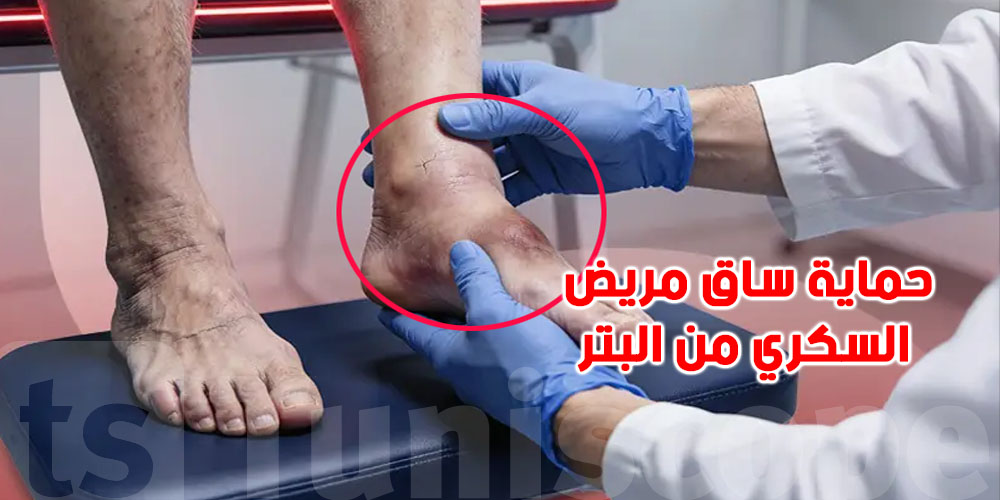 ⁨ ⁨ حماية ساق مريض السكري من البتر: اليك هذه النصائح الوقائية الأساسية