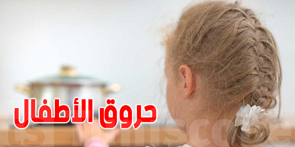 حروق الاطفال : 80 بالمائة بسبب الحوادث المنزلية حروق الاطفال : 80 بالمائة بسبب الحوادث المنزلية