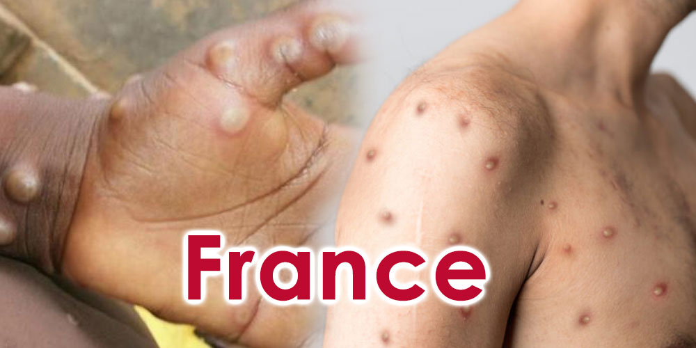 Variole du singe: la vaccination s'étend en France