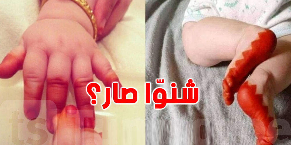 الدكتور محمد عيّادي يحذّر: طفل زعمة مات بسبب ''الحنّاء'' في طهوره