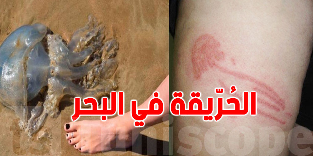 لسعة الحريقة في البحر: مخاطرها وكيفية التعامل معها