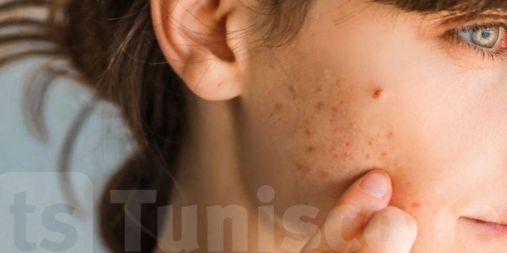 حبّيت تتخلّص من ''الكلف''؟ جرب هذي الزيوت الطبيعيّة ؟