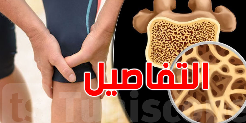هشاشة العظام في تونس: مرض صامت يهدّد حياة كبار السن