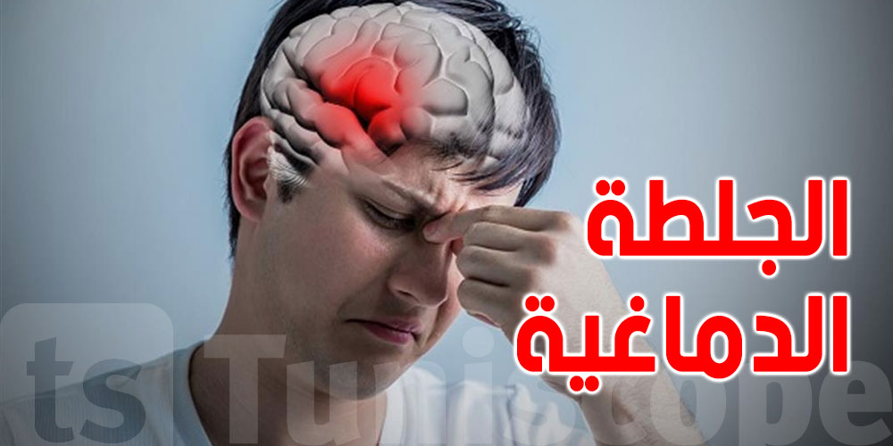 تونس تُسجّل 3 آلاف جلطة دماغية كل سنة: هذه أسبابها