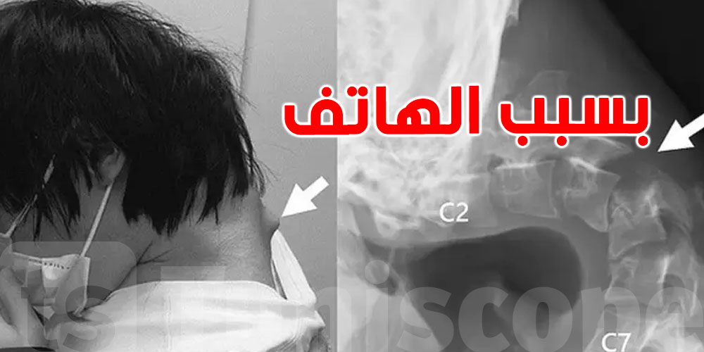 حادثة غريبة: شاب ياباني يفقد القدرة على رفع رأسه بسبب الإفراط في استخدام الهاتف!