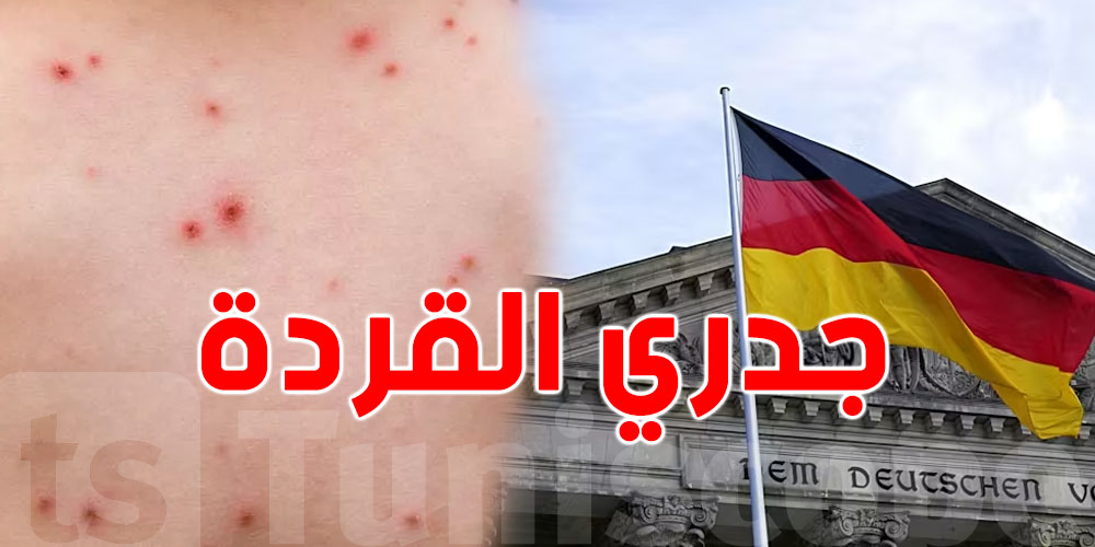 عاجل: ألمانيا تسجل أول اصابة بمرض جدري القردة