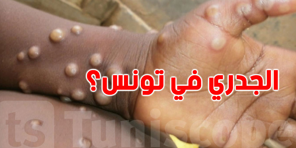 توضيح رسمي بخصوص تسجيل إصابة بالجدري في تونس