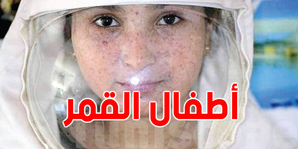 مختص في الأمراض الجلدية: تونس تقدّمت جدّا في علاج مرض ''أطفال القمر''