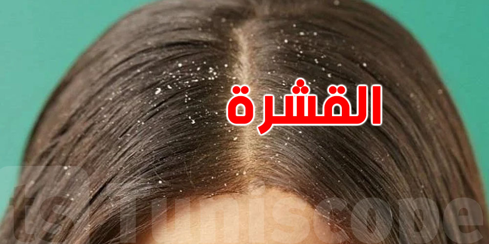 بلاش كيماويات: 4 وصفات سحرية باش تتخلص من القشرة!