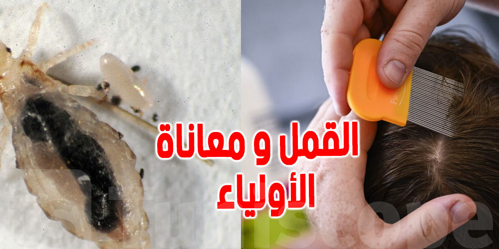 قمل الرأس موش بسبب قلة النظافة...طبيبة تكشف الحقيقة وطريقة العلاج!