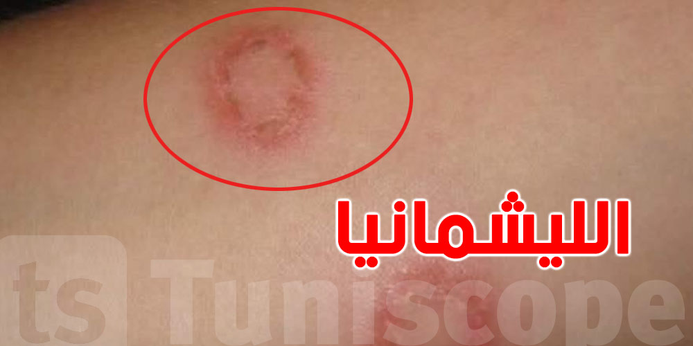 عاجل: عميد الأطباء البياطرة يطلق صرخة تحذير من داء ''الليشمانيا'' في تونس