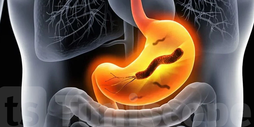 Helicobacter pylori : quels aliments peuvent aider à soulager les symptômes ?