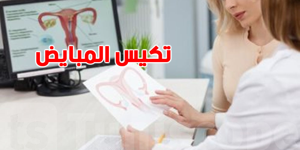 تكيس المبايض موش ساهل… إشارات لازمك تنتبهي لها