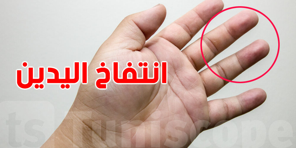 انتفاخ اليدين من غير وجيعة.. الأسباب الخفية اللي ما تخطرش على بالك