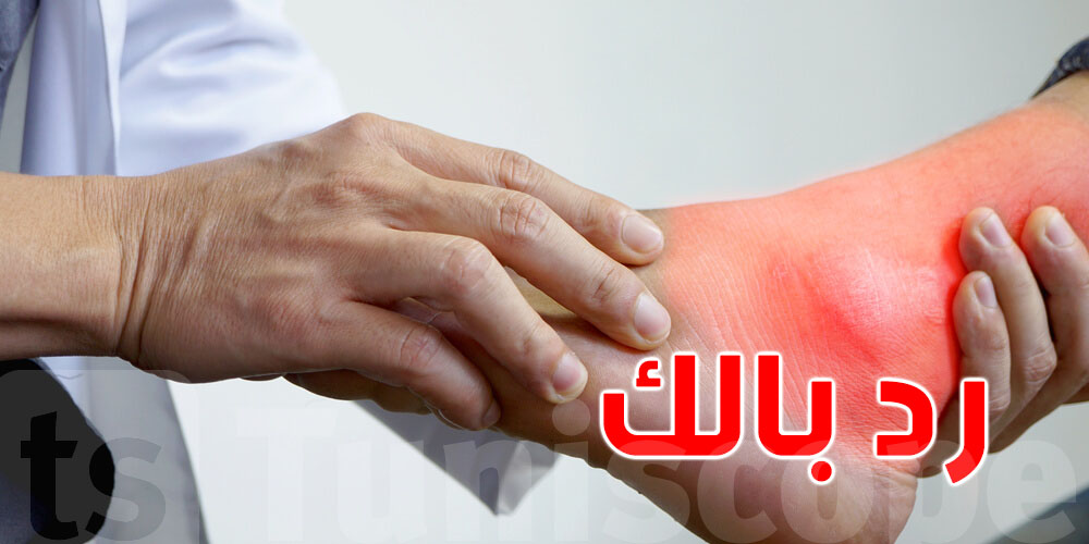 النقرس: وجيعة المفاصل إلّي تجيبها الماكلة و المشروبات.. رد بالك!