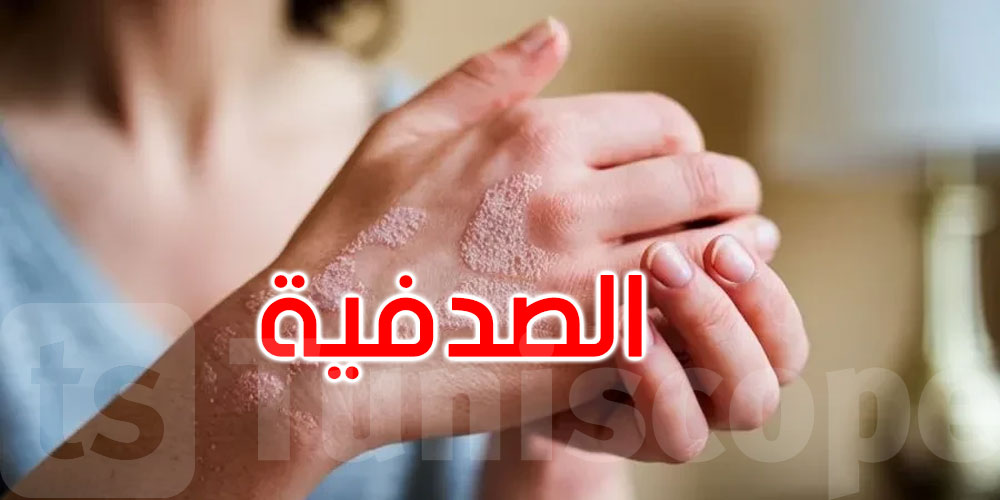  احذرها في الصيف.. عادات يومية تفاقم أعراض الصدفية