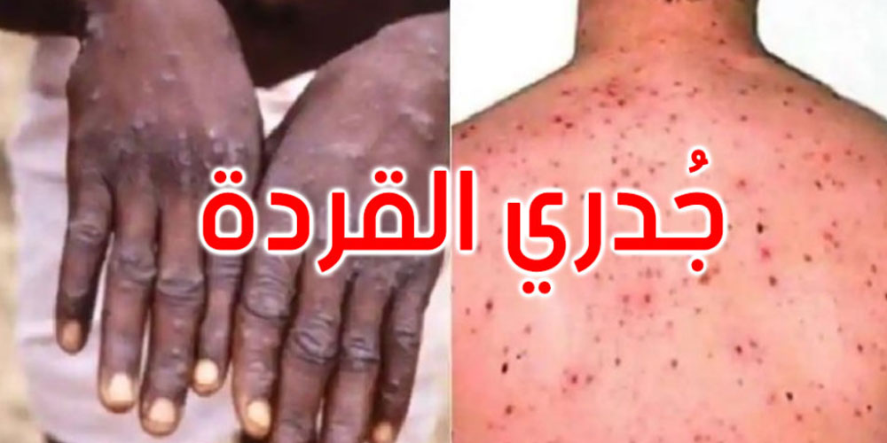 رصد إصابة بجدري القردة لعائد من الخارج في هذا البلد رصد إصابة بجدري القردة لعائد من الخارج في هذا البلد