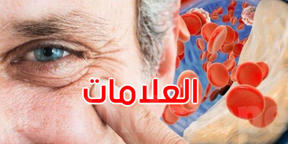 5 علامات على الوجه قد تكشف ارتفاع الكوليسترول: اكتشفها