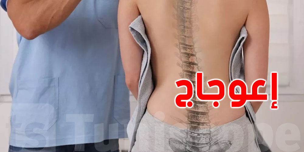 الظهر المعوّج: جرّاح تونسي يكشف ''هاو كيفاش تفيق بيه...وهذا هو الحلّ''