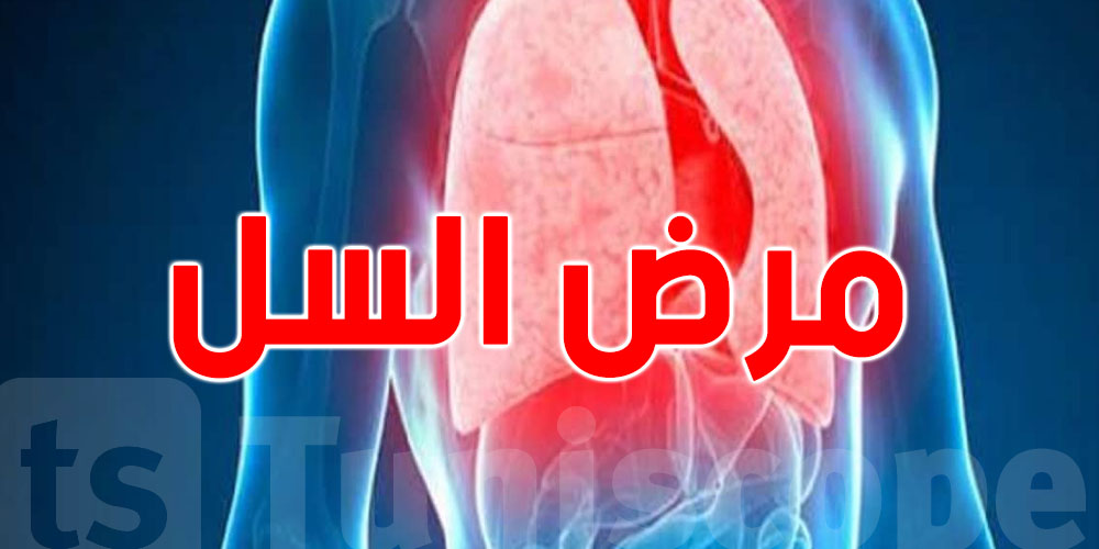 الصحة العالمية: تسجيل مستوى قياسي لحالات الإصابة بالسل 