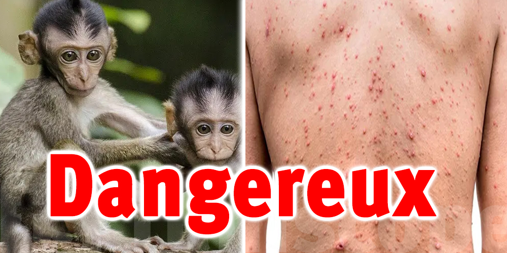 La variole du singe dans un pays voisin ? 