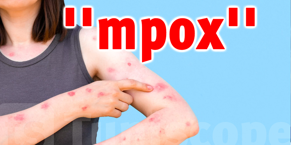 La variole du singe s’appelle désormais ''mpox ''