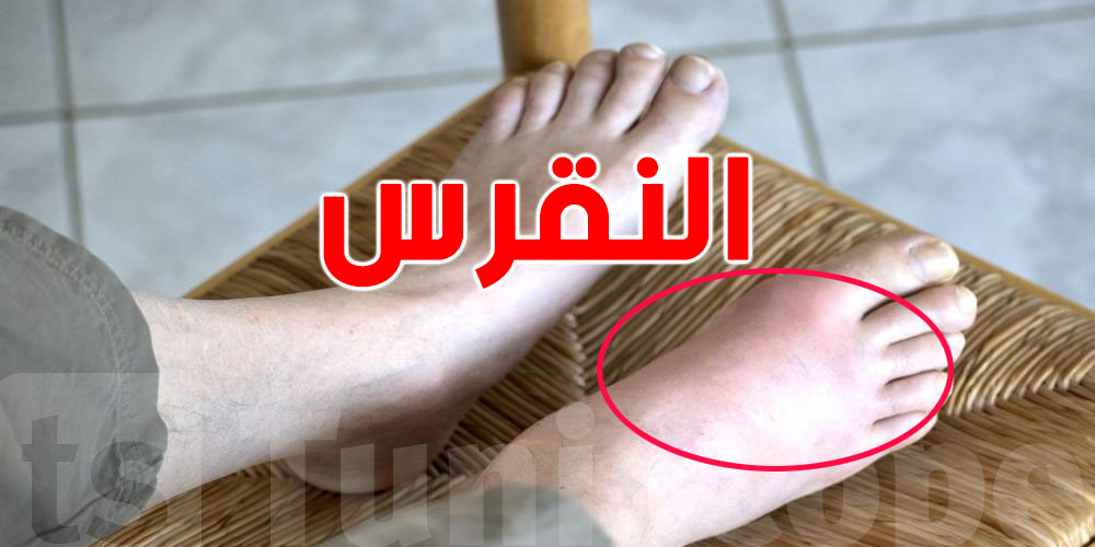 يهمّك: تعرف على مراحل النقرس وأسباب ظهوره...وأعراض النقرس اللي ما لازمش تتجاهلها