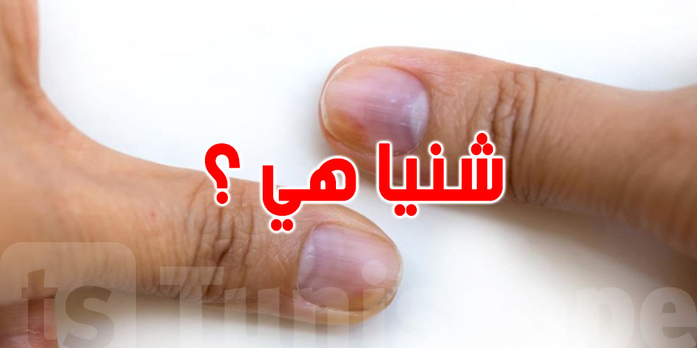 كيفاش أظافرك تنبهك لمشاكل في القلب والدورة الدموية؟