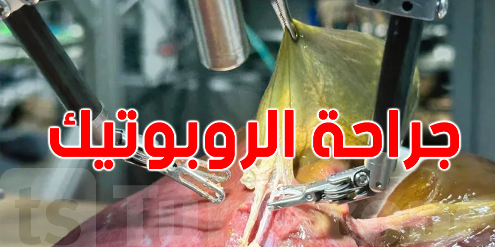 جراحة الروبوتيك: الذكاء الاصطناعي يدخل غرف العمليات في تونس