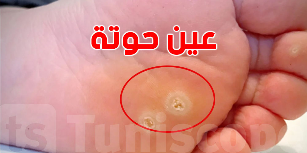 شنّوة أسباب ''عين الحوتة''؟ كيفاش تنجم تعالجها؟