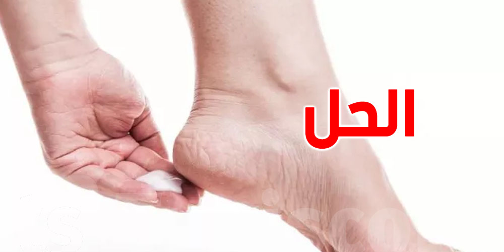 في عز الصيف.. كعبك مشقّق؟ الحل بين يديك!