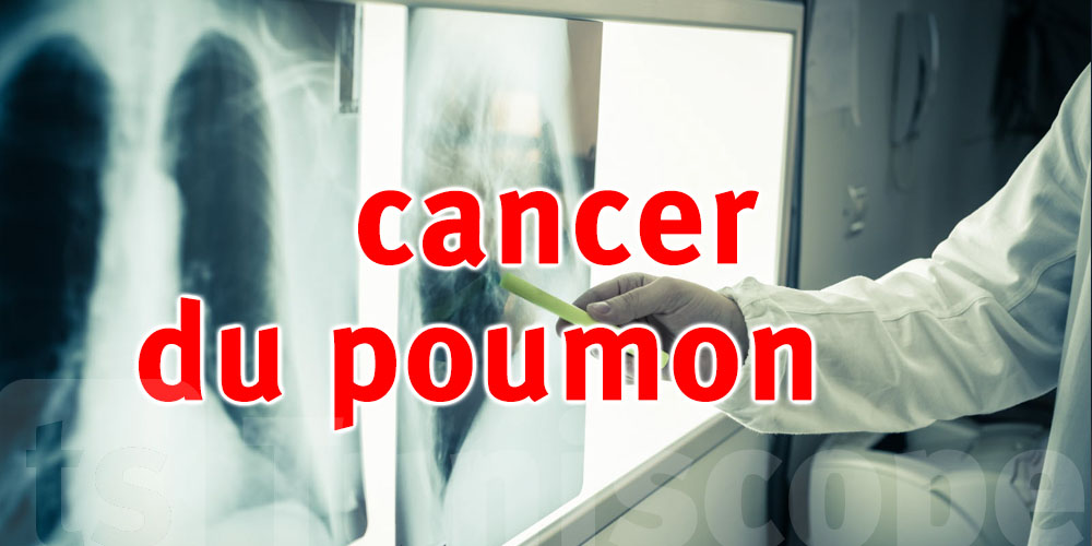 Lancement d’un programme national de dépistage précoce du cancer du poumon à partir de cette date 