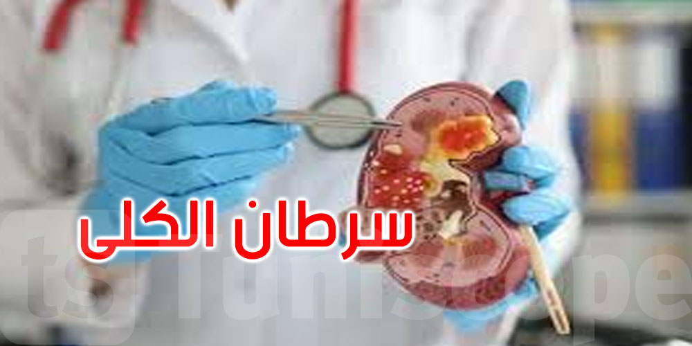 ثورة طبية.. الذكاء الاصطناعي يكشف سرطان الكلى في وقت قياسي