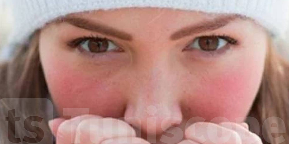 علاش احمرار الوجه في الشتاء- شوف أسبابه