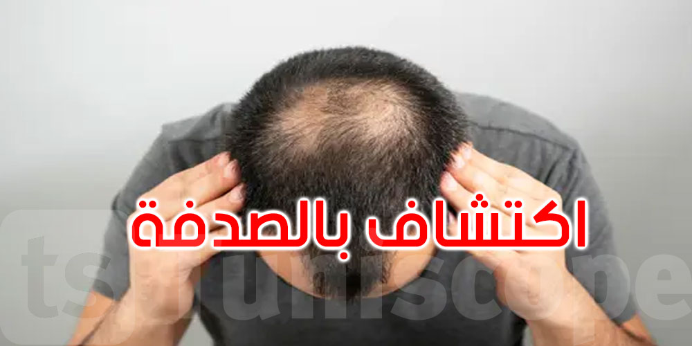 اكتشاف غير متوقع.. سكر طبيعي يحفّز نمو الشعر مجددًا