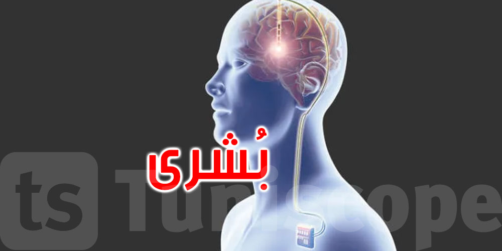 بشرى لمرضى الشلل.. شريحة في الدماغ قد تتيح التحكم بالأدوات