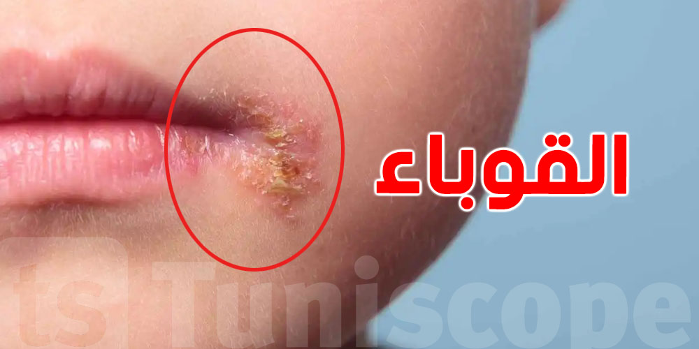 عدوى بسيطة لكنها خطيرة: ما يجب معرفته عن القوباء