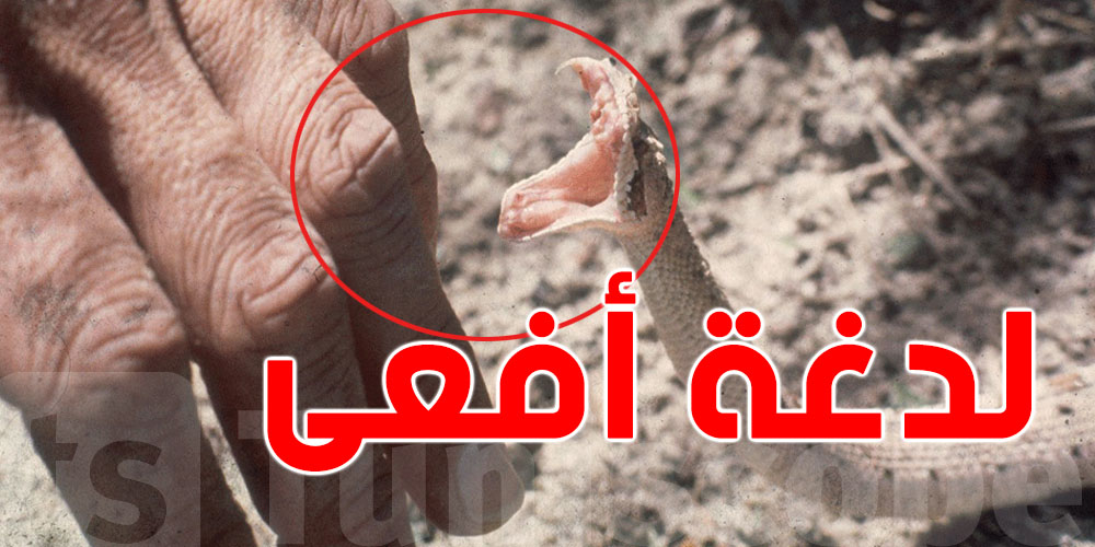 خاف من السم الأفعى.. فقرر يقطع صبعو! أسوأ قرار في تاريخ اللدغات